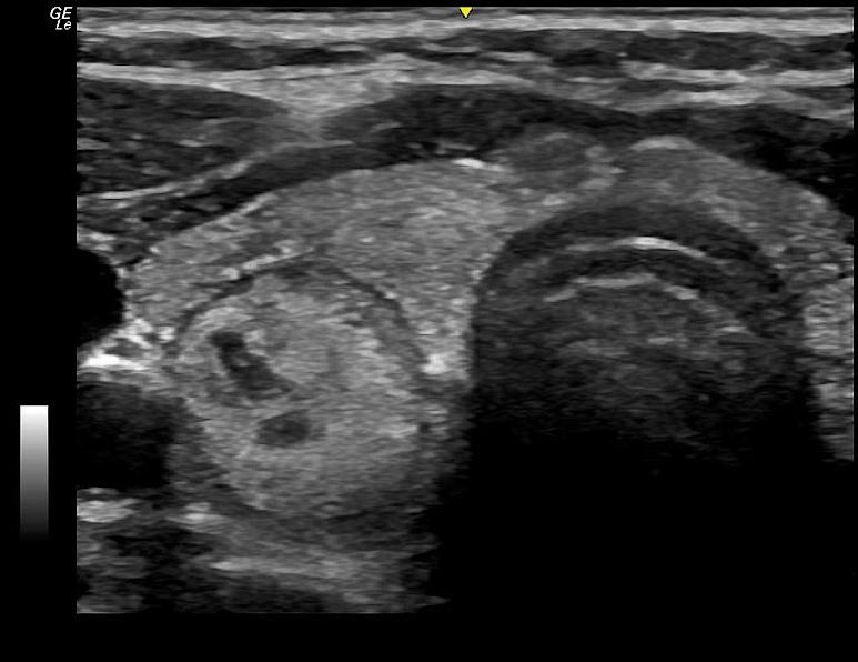 Ultrazvukový snímek uzlíku štítné žlázy