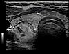 Ultraschallbild eines Schilddrüsenknotens