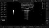 Ultrazvukový snímek lidských plic