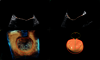 Ultrasound image captured using 4D AUTO MVQ