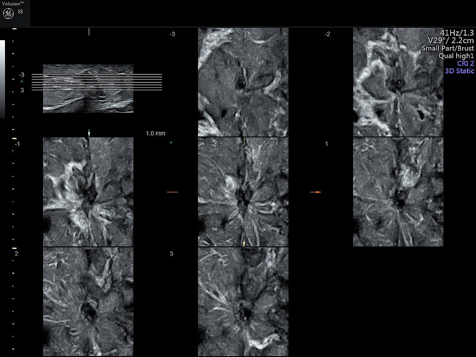 Ultraschallbild Mammasonographie mit 3D-Diagnostik