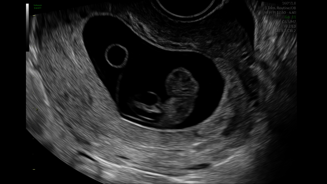 Ultrazvukový snímek devítitýdenního plodu se žloutkovým váčkem