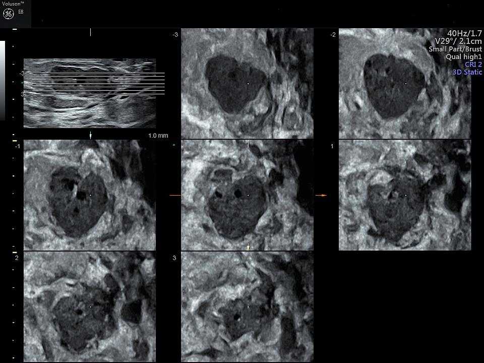 Ultraschallbild Mammasonographie mit 3D Diagnostik