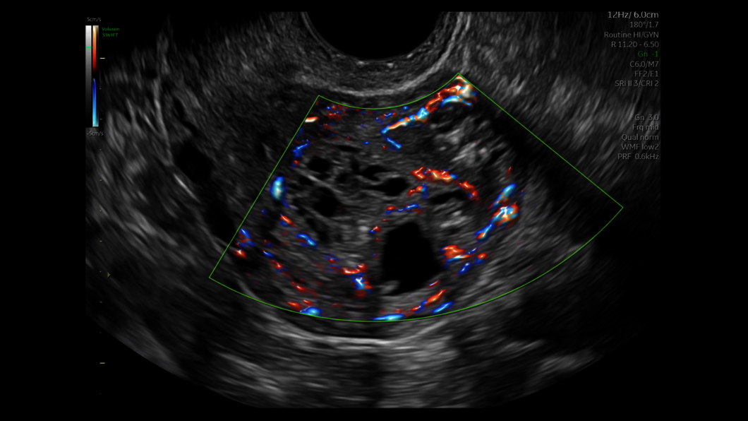 Ultrazvukový snímek dělohy zachycený pomocí funkce Radiantflow