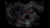 Image échographique d'un utérus avec Radiantflow
