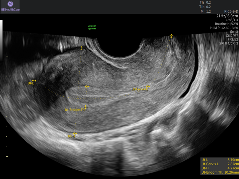 Transvaginal ultrasound of the uterus with automated SonoBiometry measurements labeled, including uterine length, cervix length, uterine height, and endometrial thickness