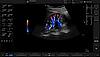 Ultrazvukový snímek ledviny zachycený s barevným tokem