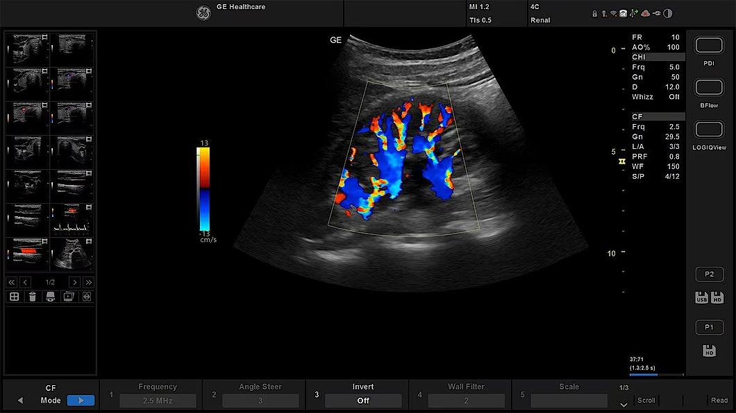 Ultrazvukový snímek ledviny zachycený s barevným tokem