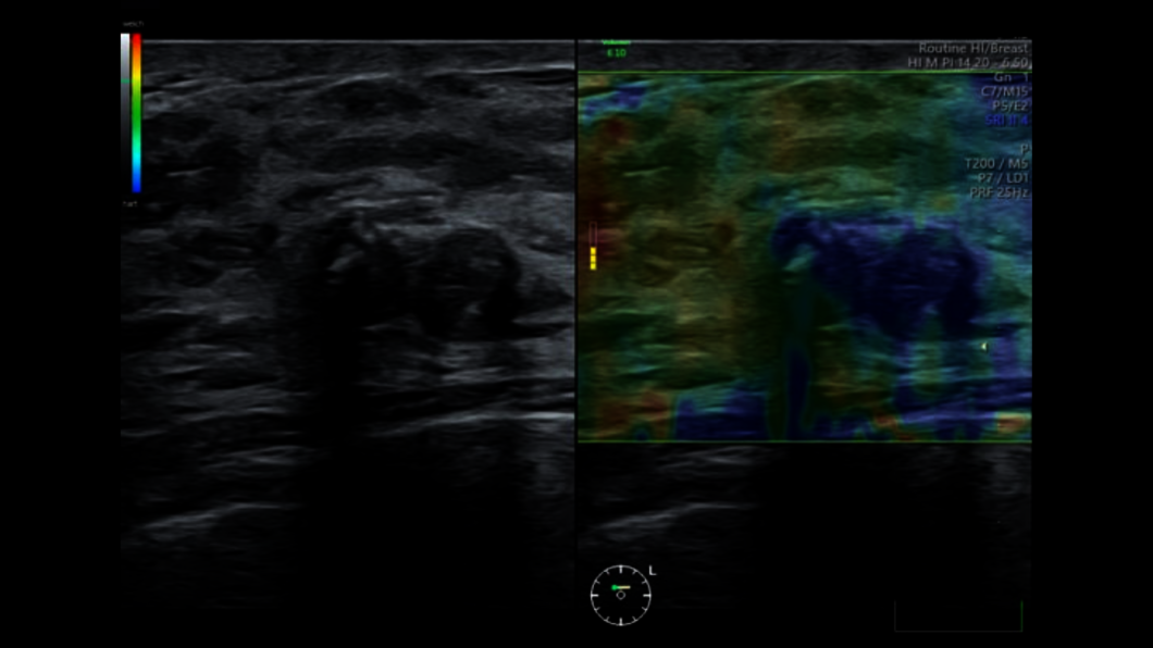 Ultraschallbild Mammasonographie mit Elastographie