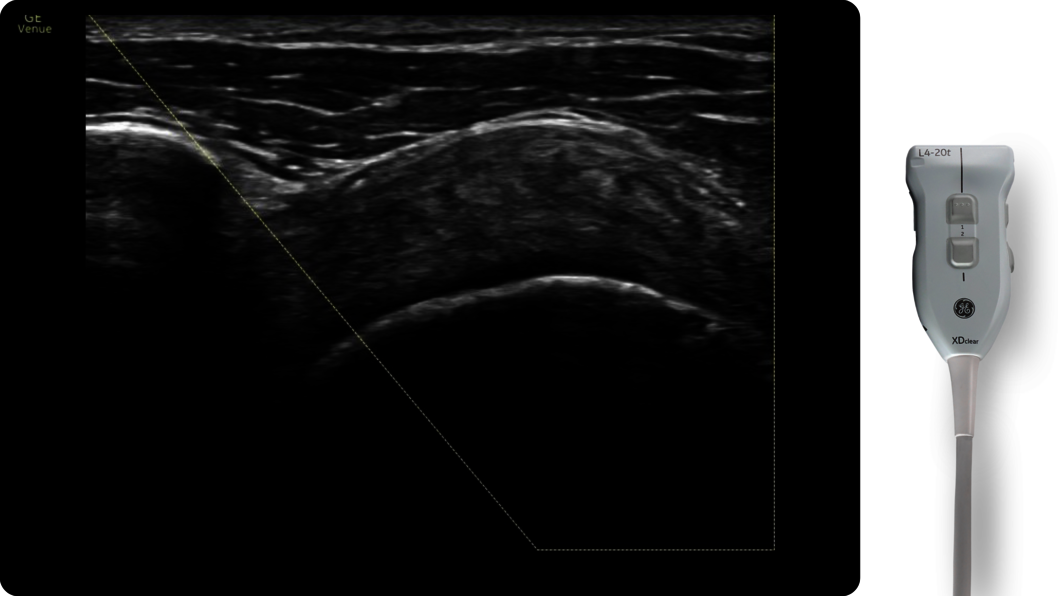 Shoulder procedure with L4-20t venue