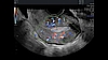 Ultrazvukový snímek dělohy zachycený pomocí funkce HD-Flow