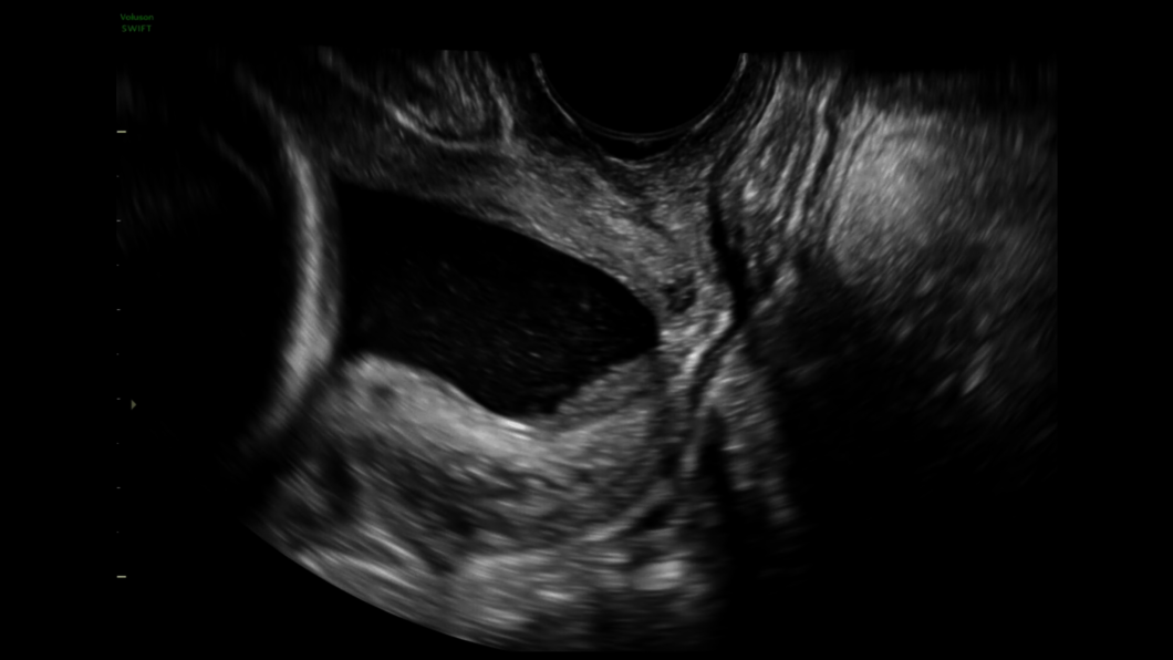 Ultrazvukový snímek: Trychtýřové vyšetření čípku