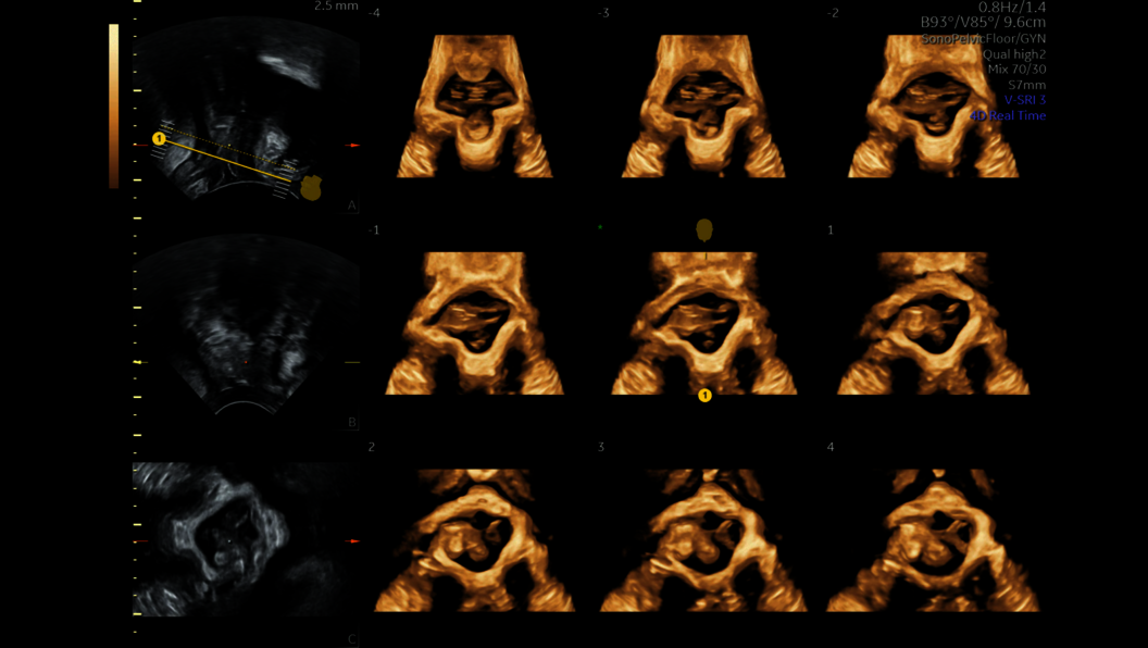 Sonopelvicfloor ultrasound image