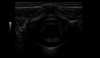 High resolution imaging of neonatal spine, L8-18i-D