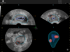 Multi-panel ultrasound showing SonoGyn analysis of an adnexal mass, with two lesions outlined in cross-sectional views and rendered in a 3D volume