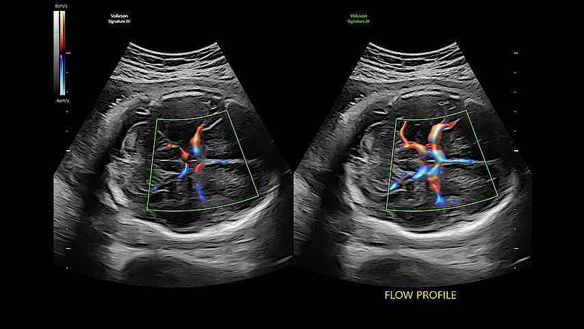 Reduce exam time by 56% with Flow Profiles. Dramatically simplifies color and pulsed-wave Doppler optimization by utilizing predefined and optimized settings.