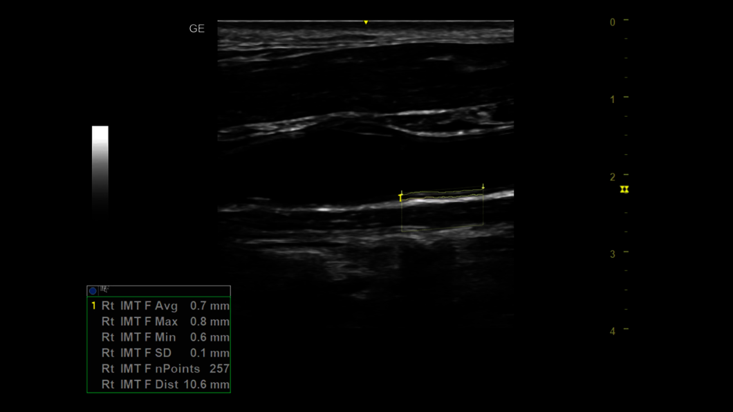 Klinický snímek při ultrazvukovém vyšetření karotidy