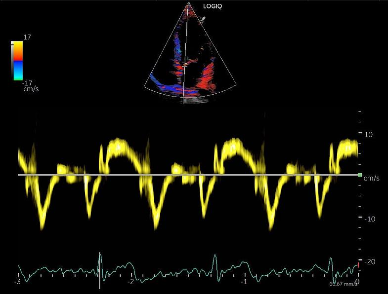 Doppler tissulaire en cardiologie, M5Sc-RS