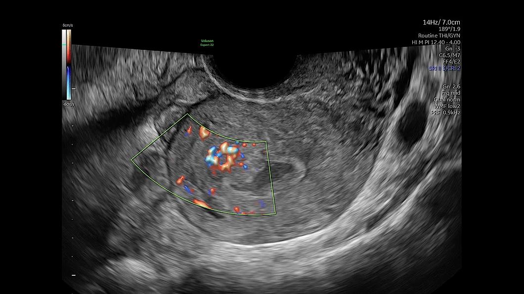 Ecografie a uterului feminin capturată cu Radiantflow