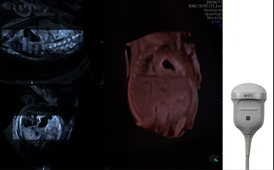 Ultrazvukový snímek zachycený pomocí objemové matricové sondy RM7C