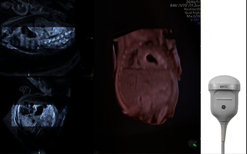 Ultrasound image captured with RM7C volume matrix probe