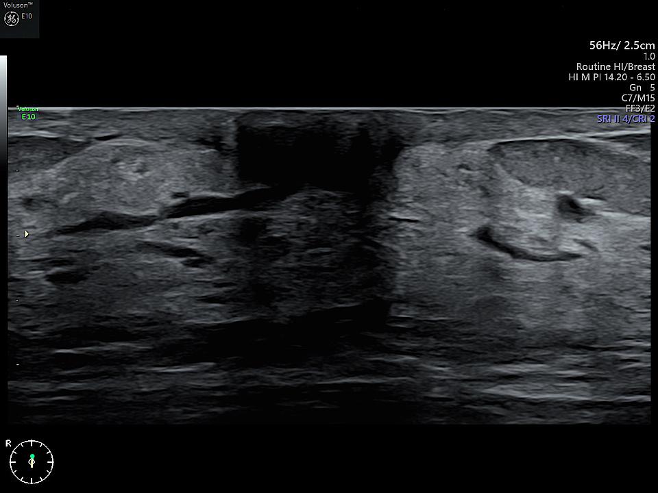 Ultraschallbild Mammasonographie mit Shadow Reduction