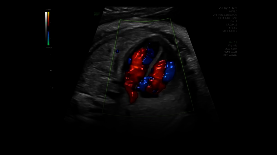 Ultrazvukový snímek zachycený pomocí funkce Radiantflow