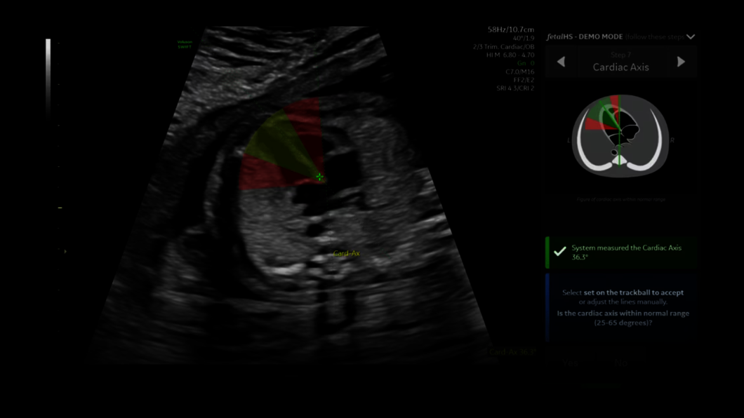 Ultraschallbild aufgenommen mit fetalem HS