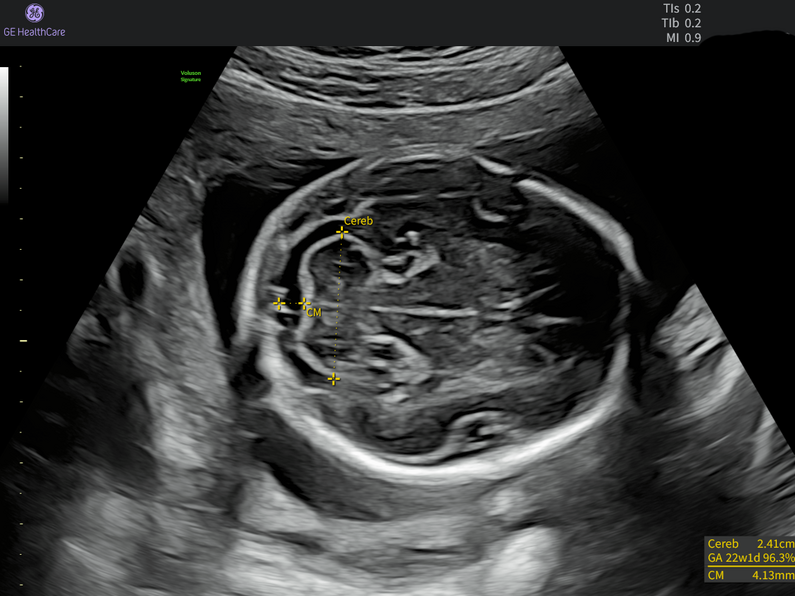 Fetal head ultrasound at 22 weeks gestation with automated SonoBiometry measurements of the cerebellum and cisterna magna