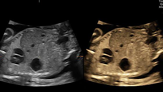 Ultrazvukový snímek zachycený pomocí objemového kontrastního zobrazování (VCI)