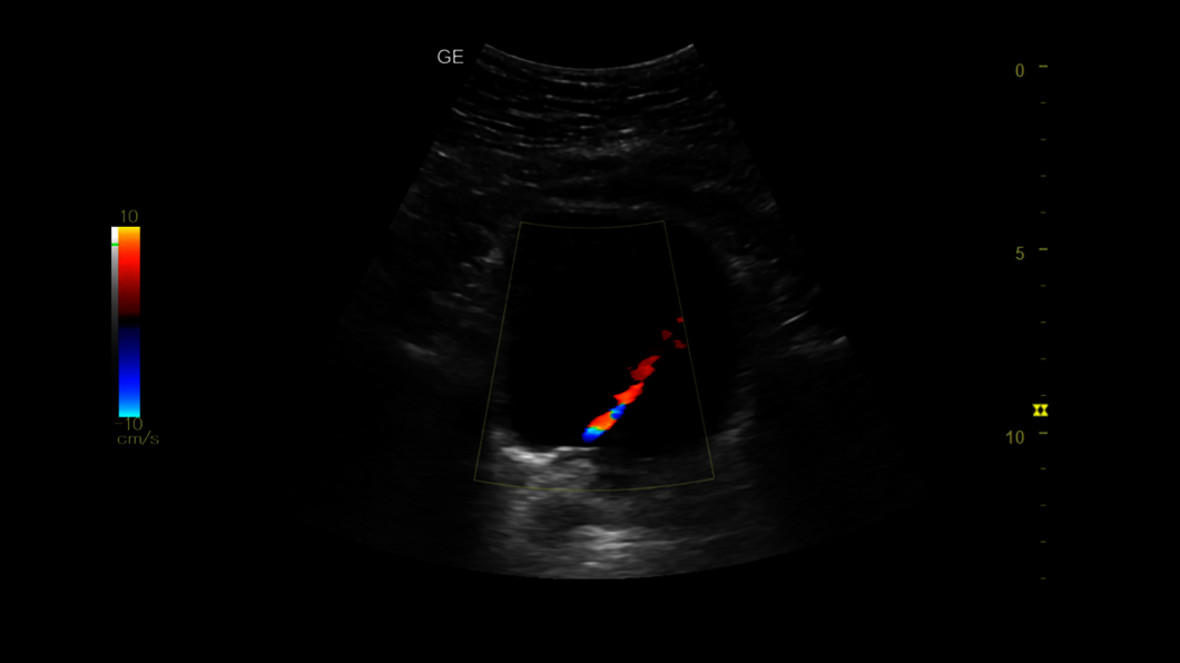 Ultrazvukový snímek močového měchýře