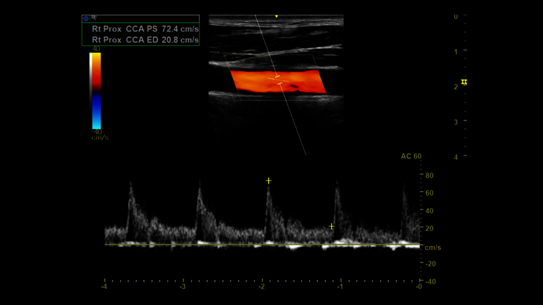 Ultrazvukový snímek při vyšetření karotid pomocí spektrálního Doppleru