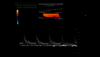 Image échographique d'un examen de la carotide en Doppler pulsé