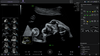 Voluson ultrasound interface showing SonoLyst automated 2nd trimester anatomy checklist with fetal head, heart, abdominal, spine, and extremity views, alongside a 3D rendering of fetal orbits.