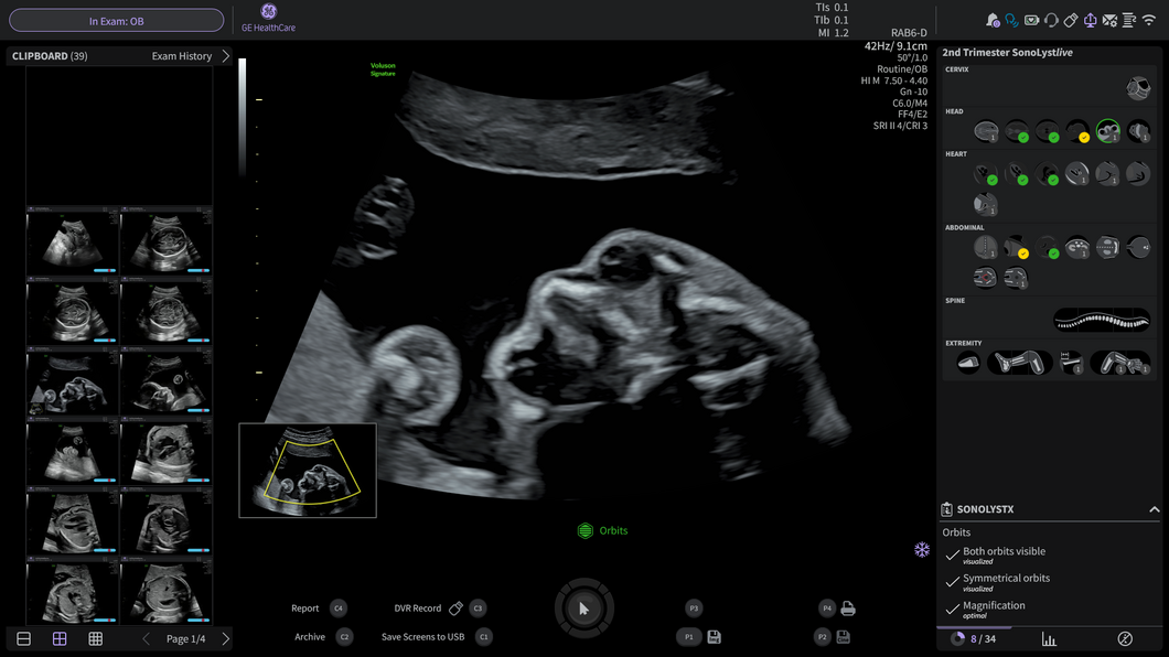 Voluson ultrasound interface showing SonoLyst automated 2nd trimester anatomy checklist with fetal head, heart, abdominal, spine, and extremity views, alongside a 3D rendering of fetal orbits.
