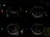 Image échographique du cerveau fœtal avec l'outil SonoCNS