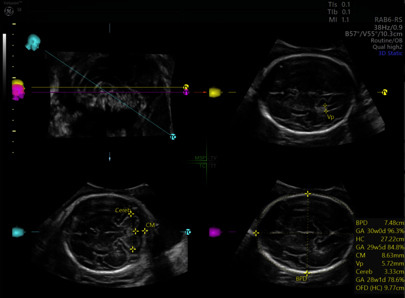 Ultrazvukový snímek fetálního mozku zachycený pomocí funkce SonoCNS