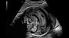 Ultrazvukový snímek mozku plodu zachycený pomocí funkce HDRes