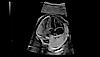 22 week fetal heart