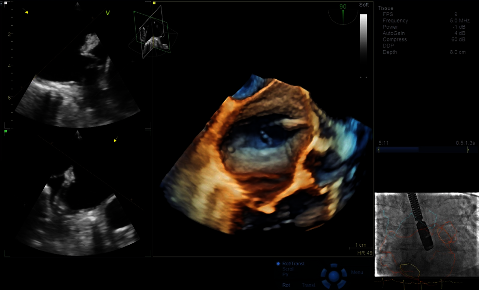 Ultrazvukový snímek zachycený pomocí funkce View-X