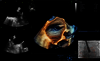 Ultrazvukový snímek zachycený pomocí funkce View-X