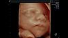 Ultrazvukový snímek fetálního obličeje zachycený pomocí funkce HDlive