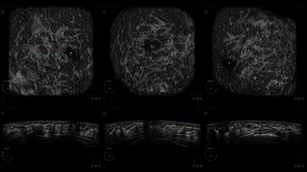 Ultrazvukový snímek ženského prsu