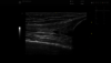 Ultrazvukový snímek: L312 koleno EZ2