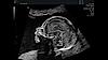 Ultrazvukový snímek fetálního profilu