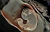 Image échographique d'un fœtus avec HDlive Silhouette