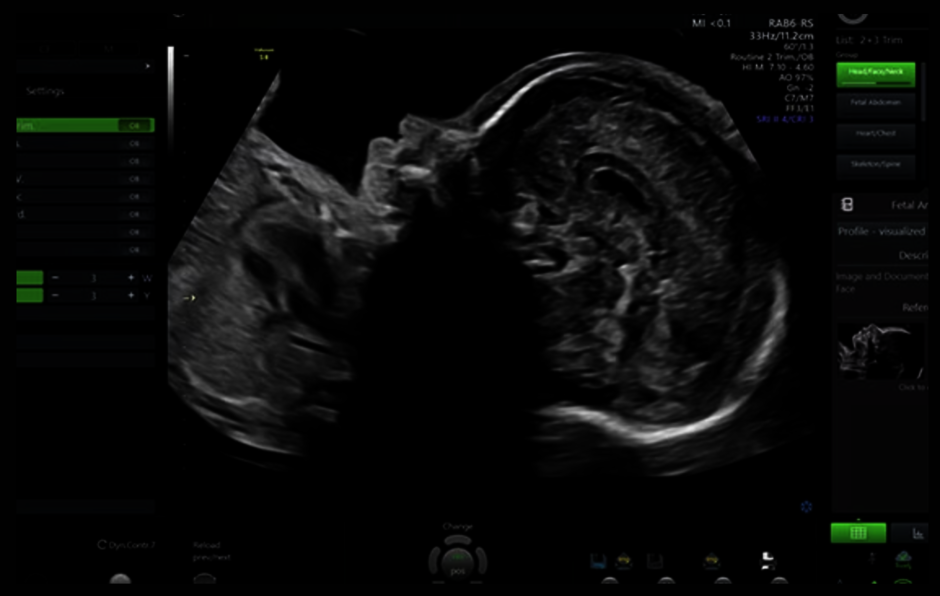 Ultrazvukový snímek zachycený pomocí funkce Scan Assistant