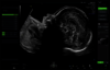 Ultrazvukový snímek zachycený pomocí funkce Scan Assistant