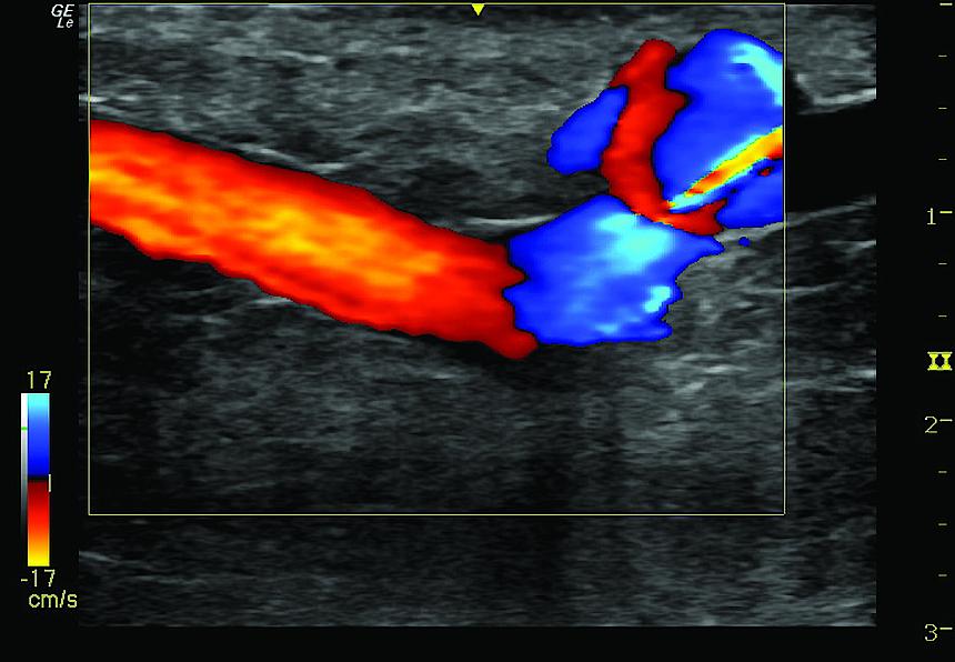 Ultrasound image of a vein examination