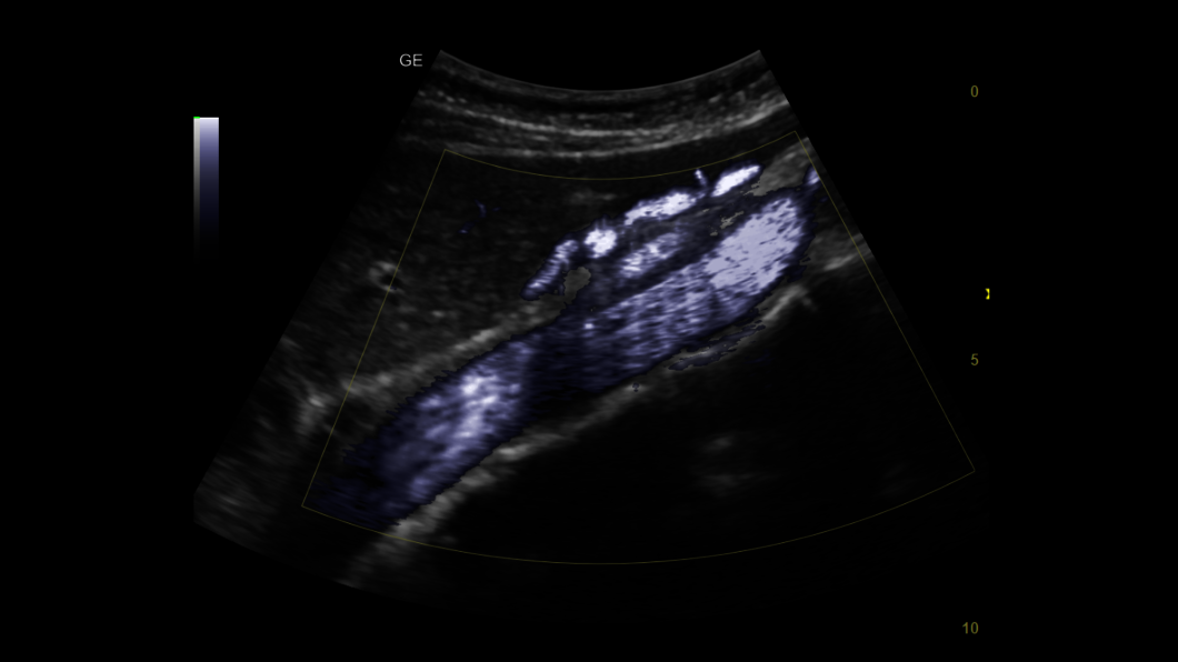 Břišní aorta B Flow v barvě, 4C-RS